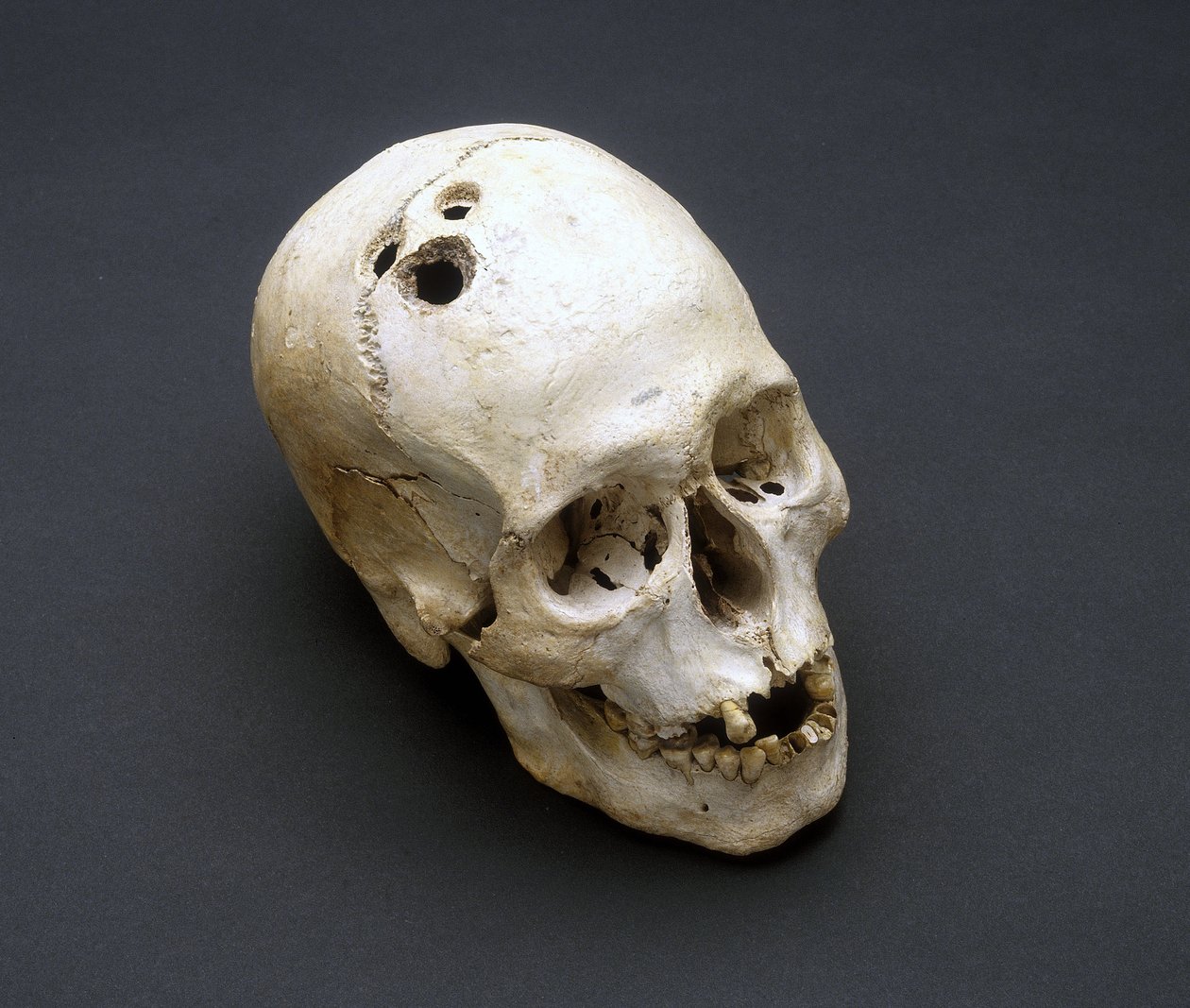 Trefinacja czaszka z epoki brązu, Jerycho, Palestyna, 2200-2000 pne autorstwa Unbekannt Unbekannt