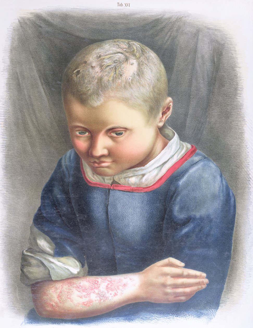 Favus, z książki Daniela Corneliusa Danielssena (1815-94) 1892 autorstwa Norwegian School