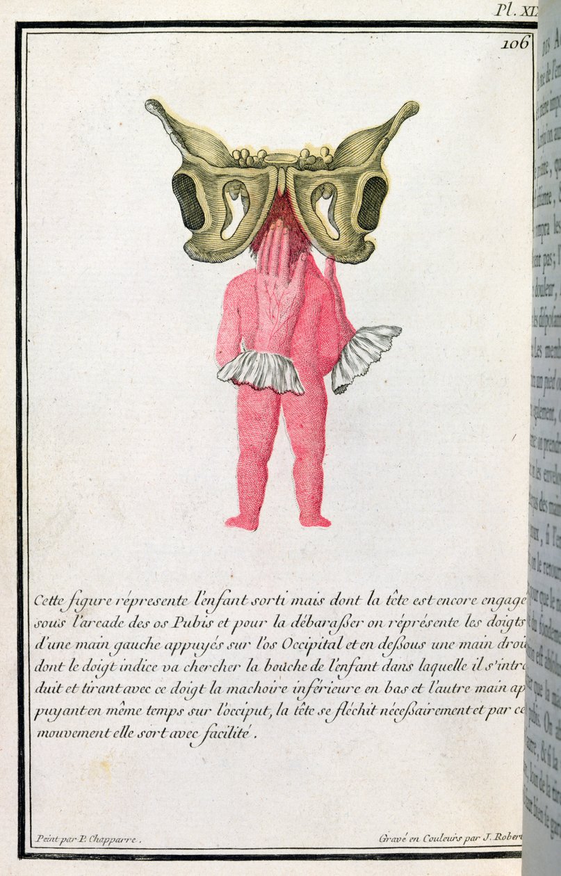 Schemat przekrojowy dziecka wyciągniętego z łona, z książki Madame Angelique Le Boursier du Coudray (1714-94) grawerowanego przez J. Roberta, 1783 autorstwa P. Chapparre