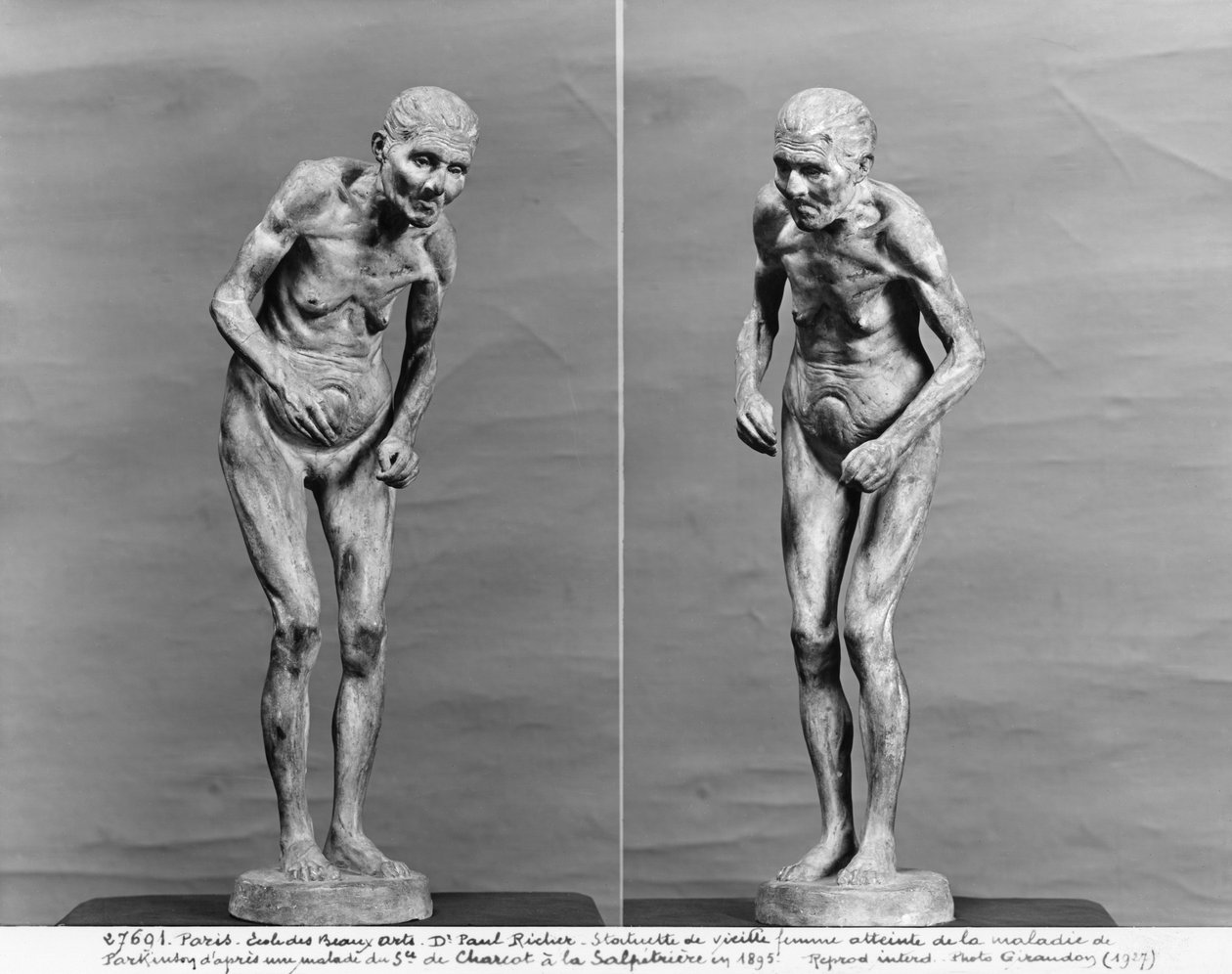 Statuetka starej kobiety z chorobą Parkinsona, po 1895 (gips) autorstwa Paul Marie Louis Pierre Richer