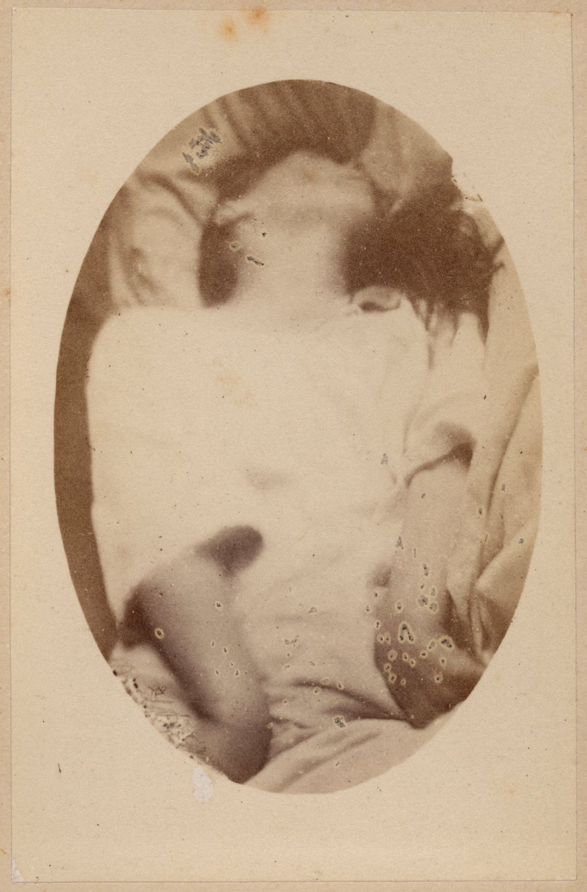 Epilepsja histeryczna, atak, faza epileptoidalna, ilustracja z "Iconographie Photographique de La Salpetriere" Bourneville et P. Regnard, płyta XVII, Paryż, 1876 (odbitka albuminowa) autorstwa Paul Regnard