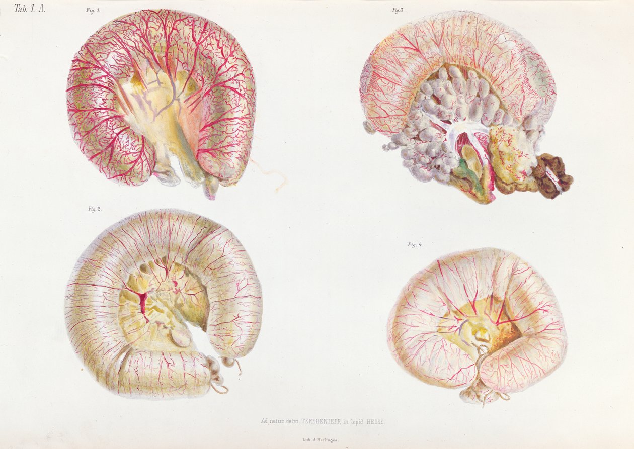 Zewnętrzna powierzchnia jelit zakażonych cholerą, z Anatomie Pathologique du Cholera Morbus, Nikołaja Iwanowicza Pirogowa (1810-81) opublikowanej w Petersburgu, 1849 autorstwa Russian School