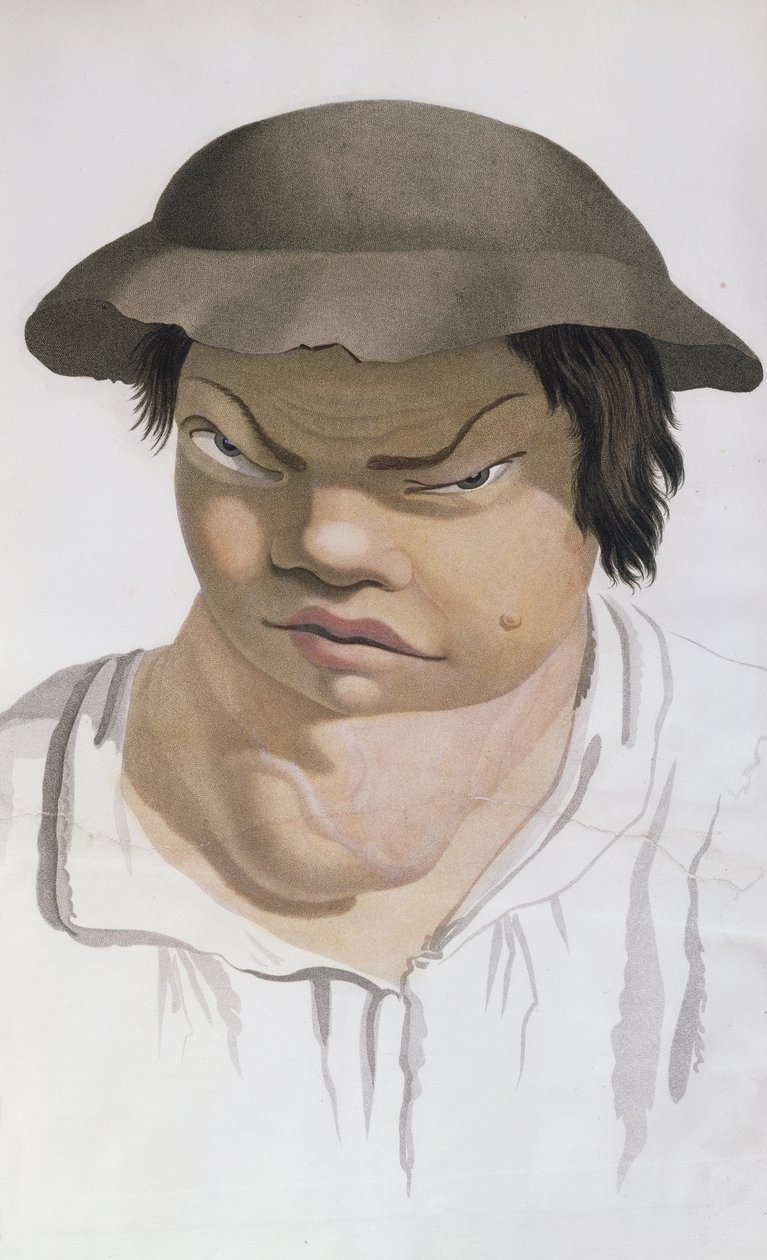 Endemiczny Scrofula, ilustracja z książki barona Jean Louis Alibert (1768-1837) autorstwa Salvadore Tresca