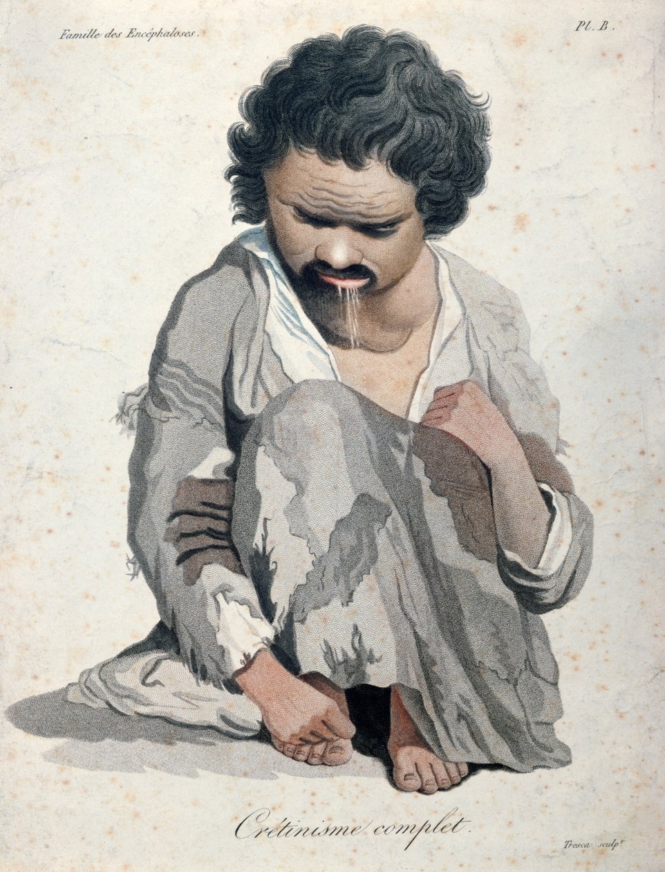 Totalny kretynizm, z książki barona Jean Louis Alibert (1768-1837) autorstwa Salvadore Tresca