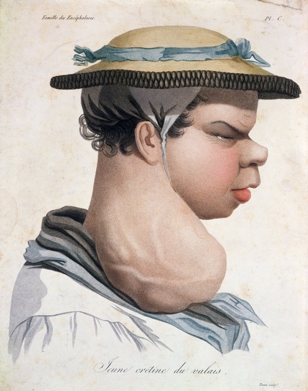 Młody Kretyn z Wallis, ilustracja z książki barona Jean Louis Alibert (1768-1837) autorstwa Salvadore Tresca