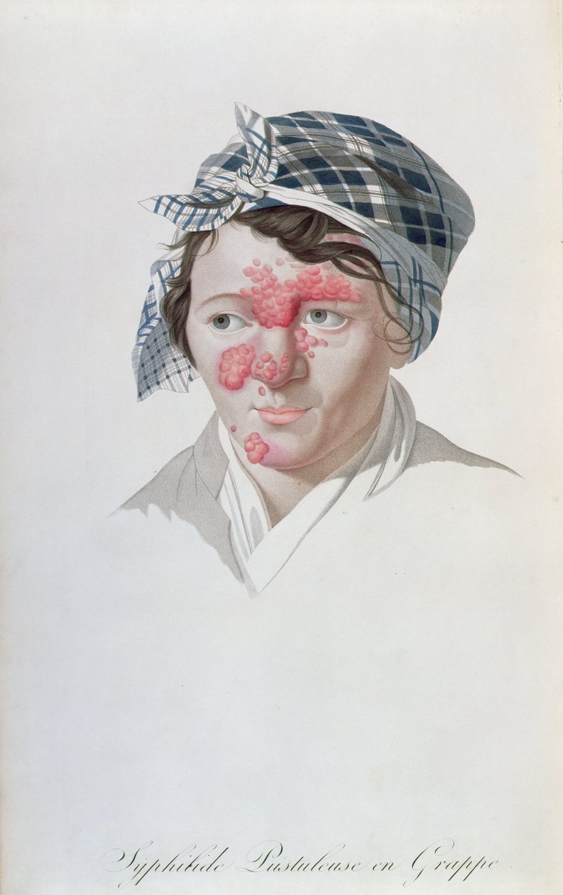 Krosty kiły, z książki barona Jeana Louisa Aliberta (1768-1837) 1838 autorstwa Salvadore Tresca