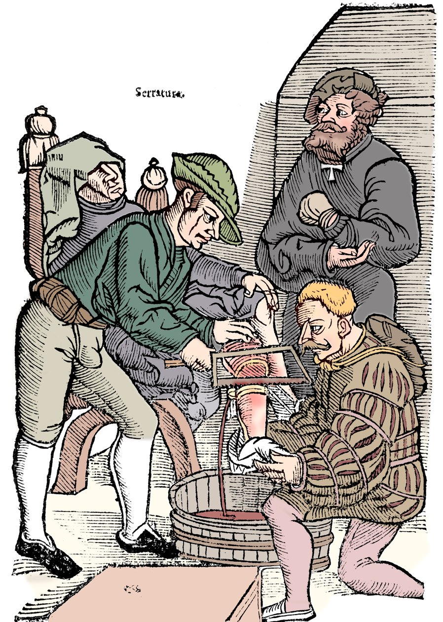 Amputacja nogi bez znieczulenia, 1593 autorstwa Unbekannt