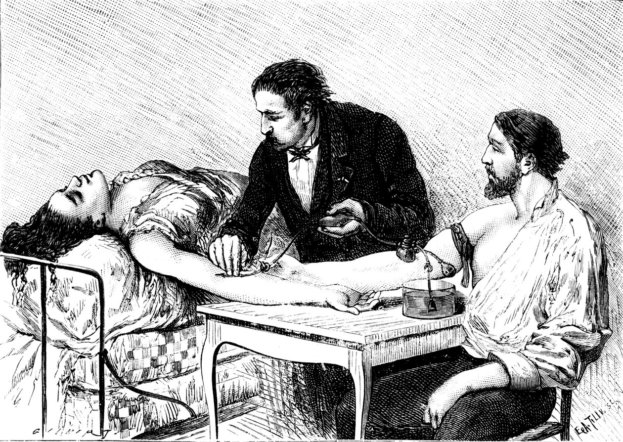 Dr Roussell z Genewy poddający kobiecie bezpośrednią transfuzję krwi od wolontariusza, 1882 r. autorstwa Unbekannt