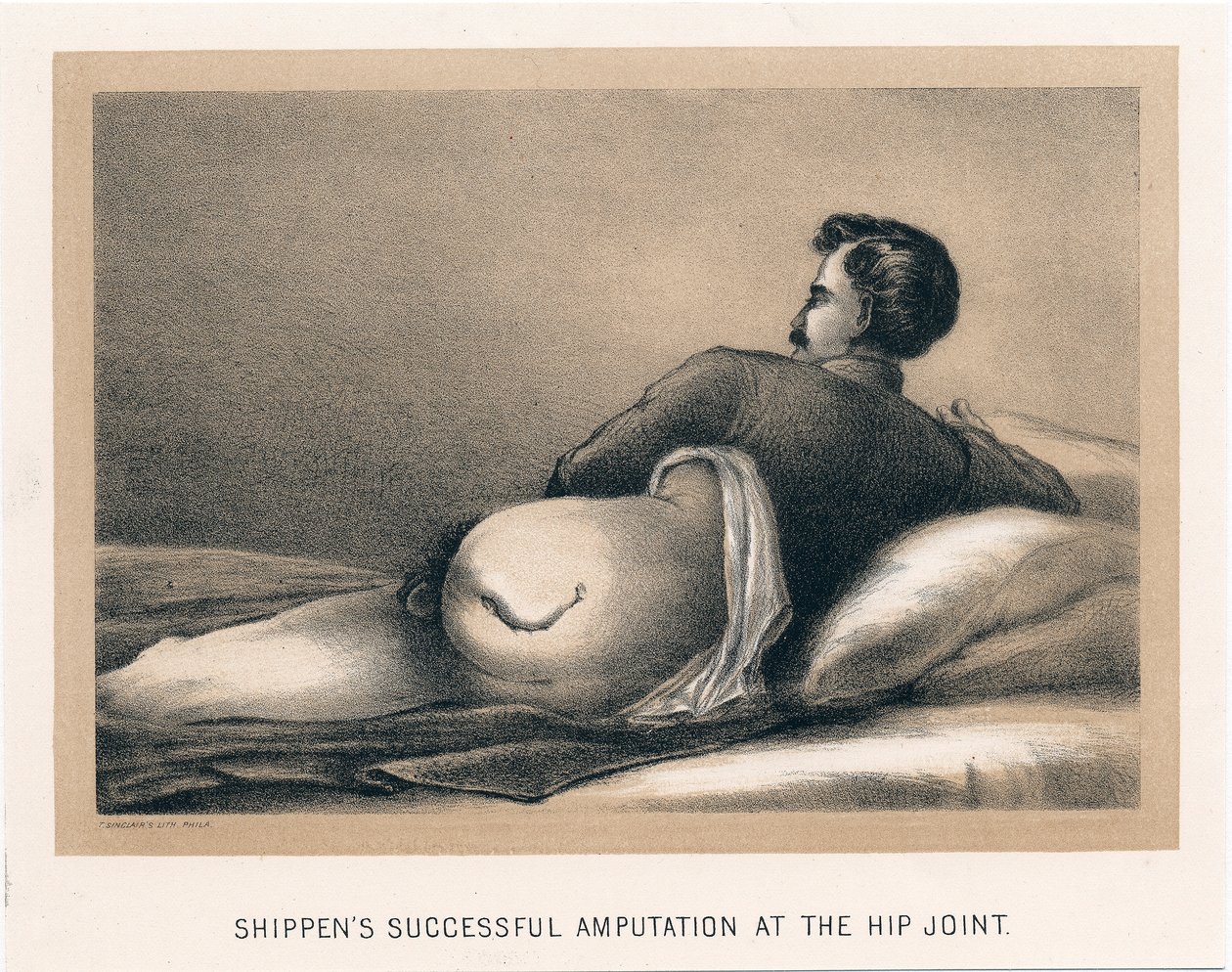 Shippens udana amputacja stawu biodrowego, wojna secesyjna, 1865 autorstwa Unbekannt