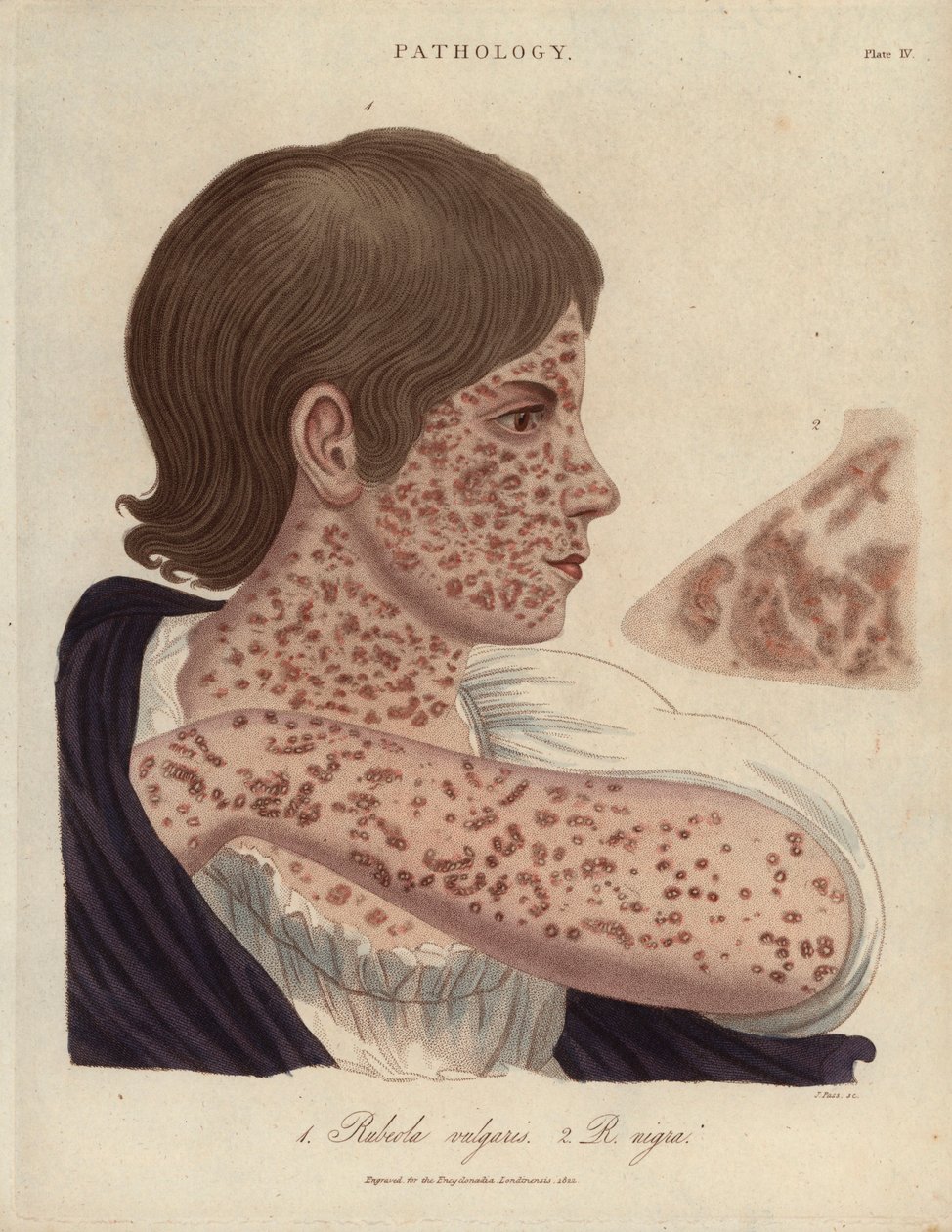 Measles and Rubeole - litografia autorstwa Johna Passa, opublikowana w "Encyclopedia Londinensis" Johna Wilkesa, wyd. J.Adlard, Londyn autorstwa Unbekannter Künstler