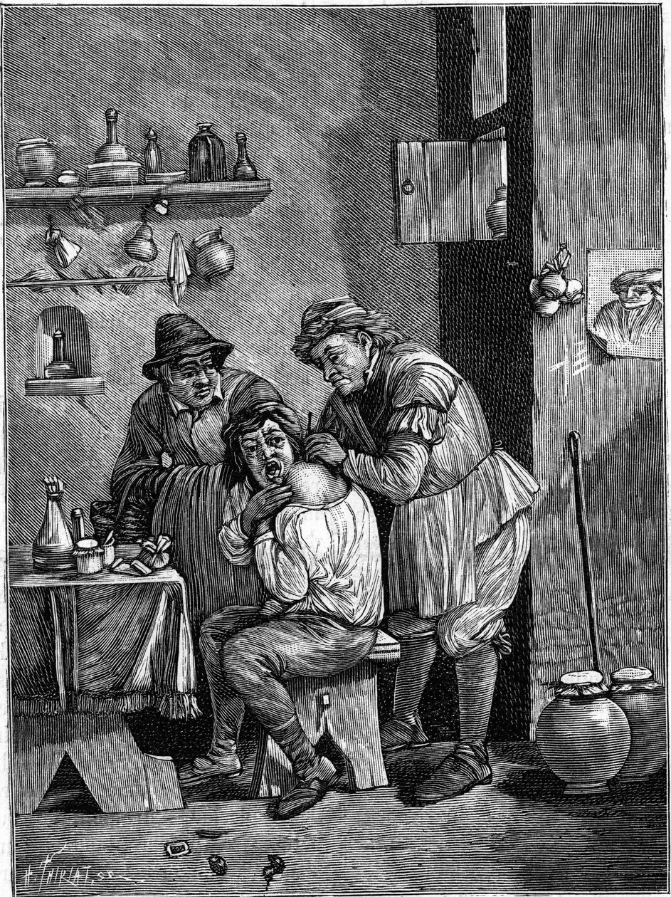 Szarlatan chirurg w XVIII wieku badający uraz barku. (Z grawerunku czasu). Grawerowanie w „”La Nature: revue des sciences et de leurs applications aux arts et a l