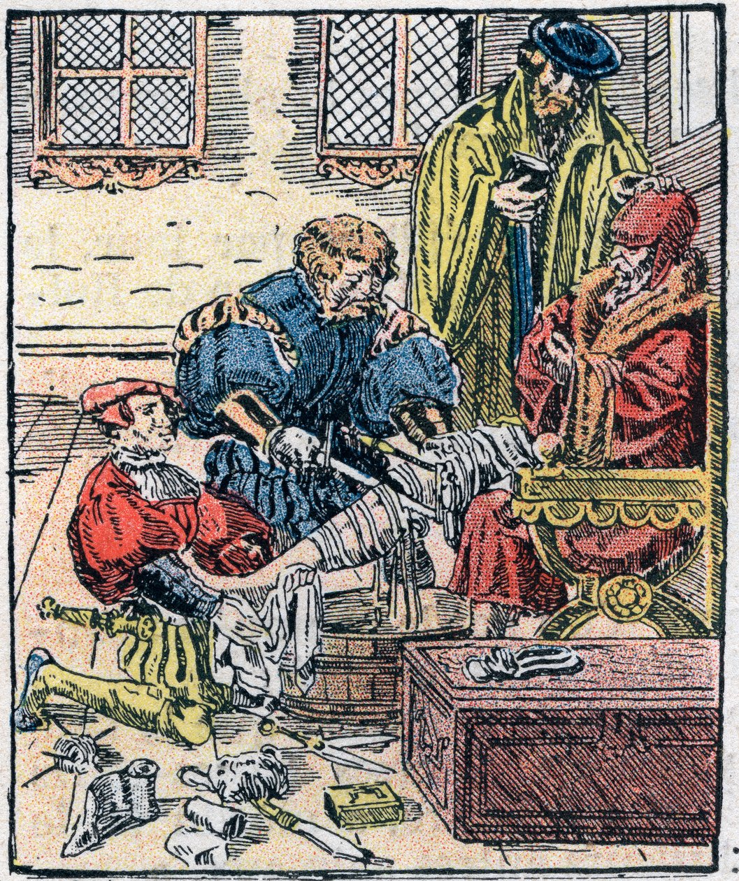 Amputacja nogi w XVI wieku. autorstwa Unknown artist
