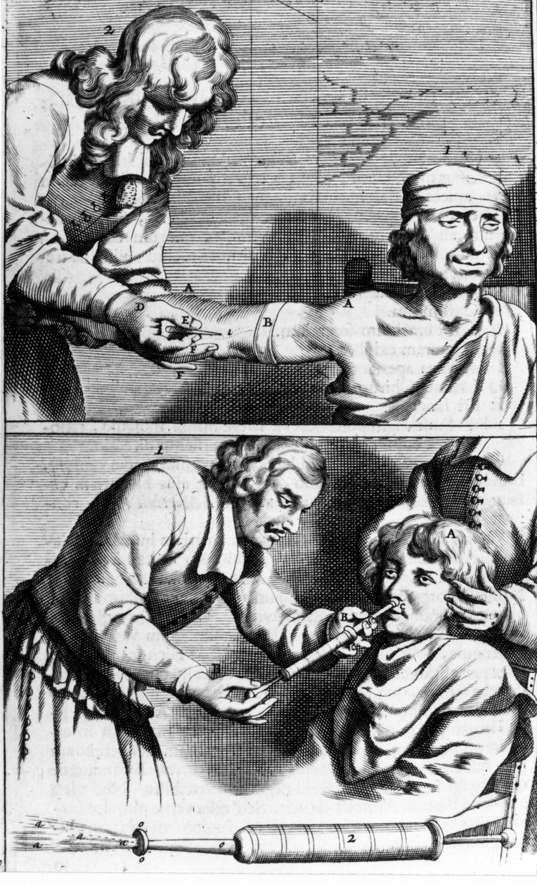 Krwawienie i prysznic do nosa – Johannes Sculpteti „”Armamentarium Surgery”” Amsterdam 1672 autorstwa Unknown artist