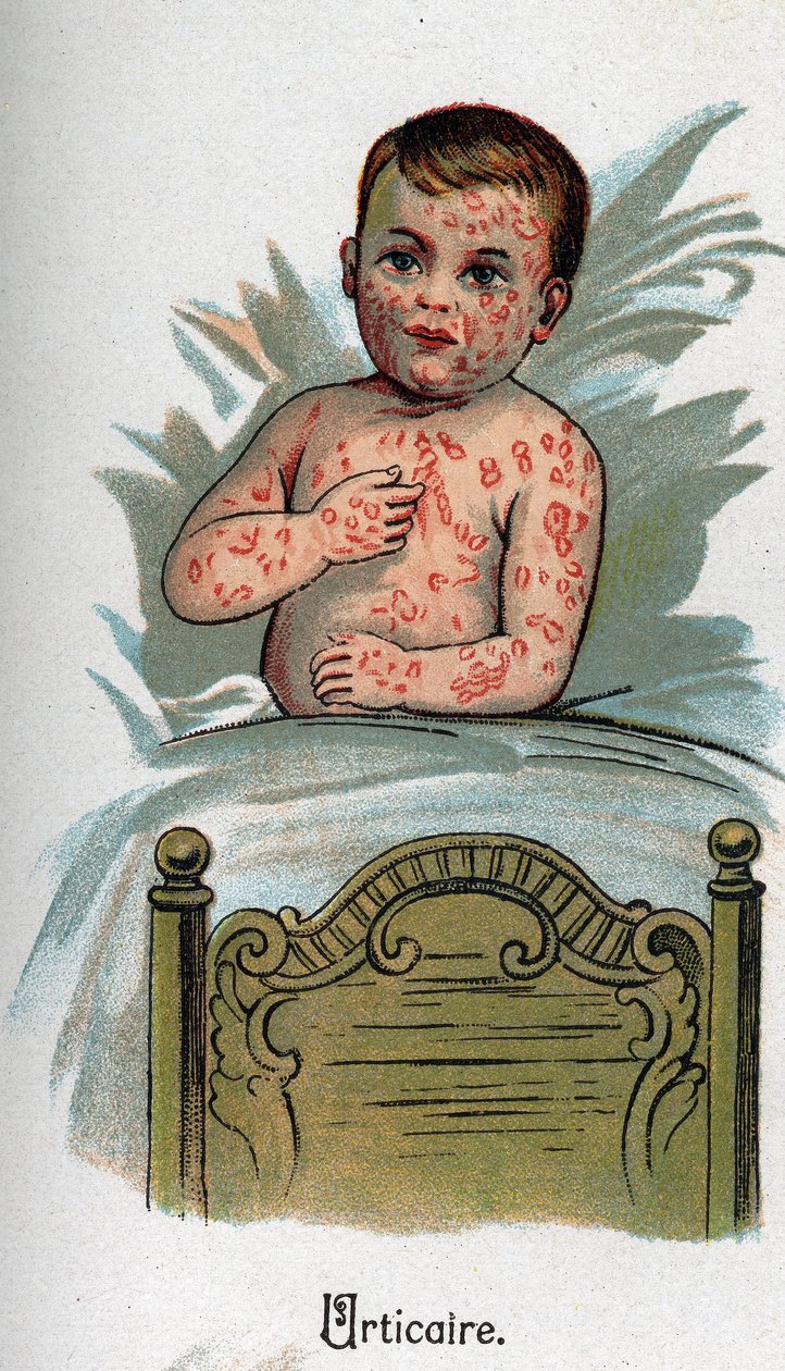 Choroby dzieci: pokrzywka. W „Nowej medycynie naturalnej” F.E. Bilza. autorstwa Unknown artist