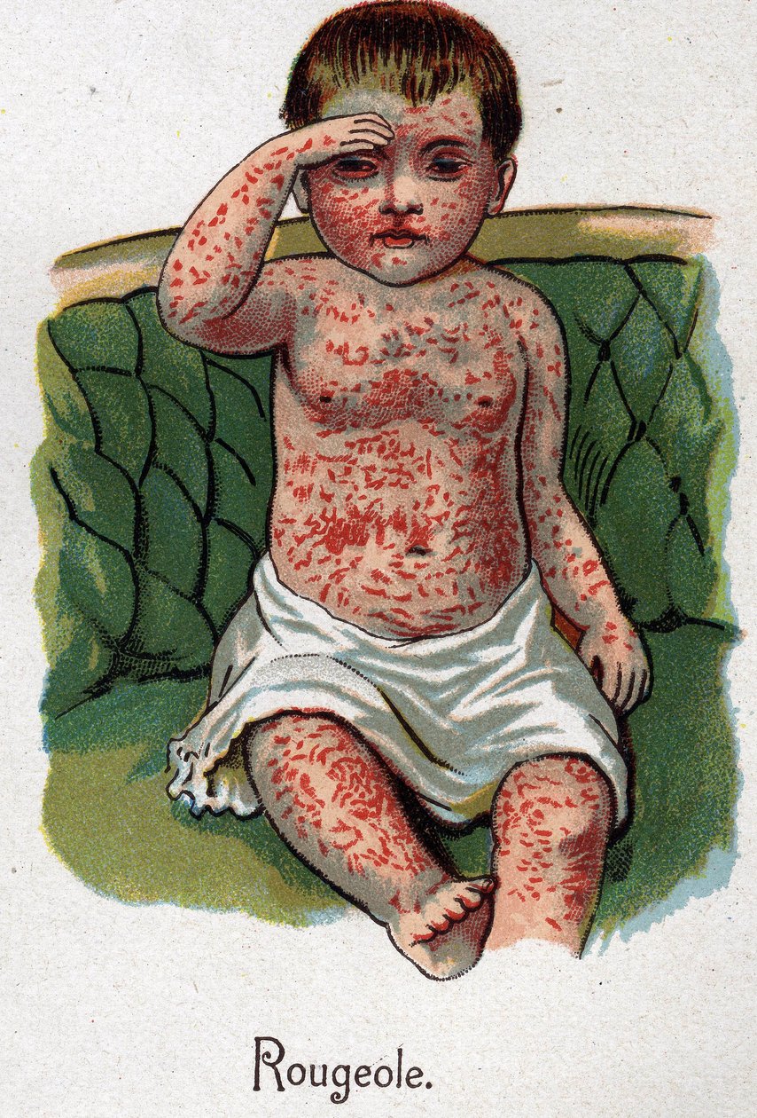 Choroby dziecięce: odra. W „Nowej medycynie naturalnej” F.E. Bilza. autorstwa Unknown artist
