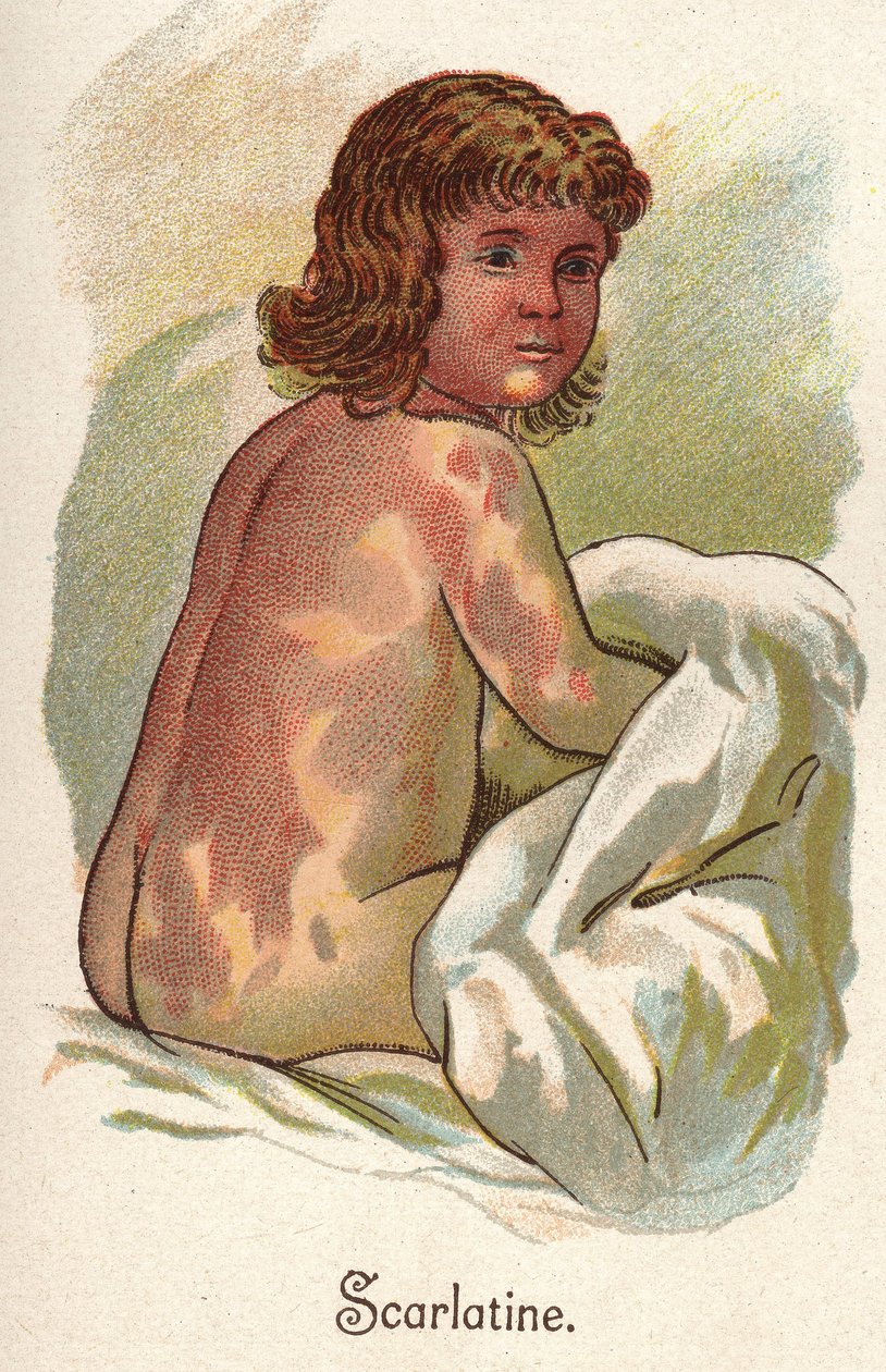 Choroby dzieci: szkarlatyna. W „Nowym naturalnym leku” F.E. Bilz. autorstwa Unknown artist
