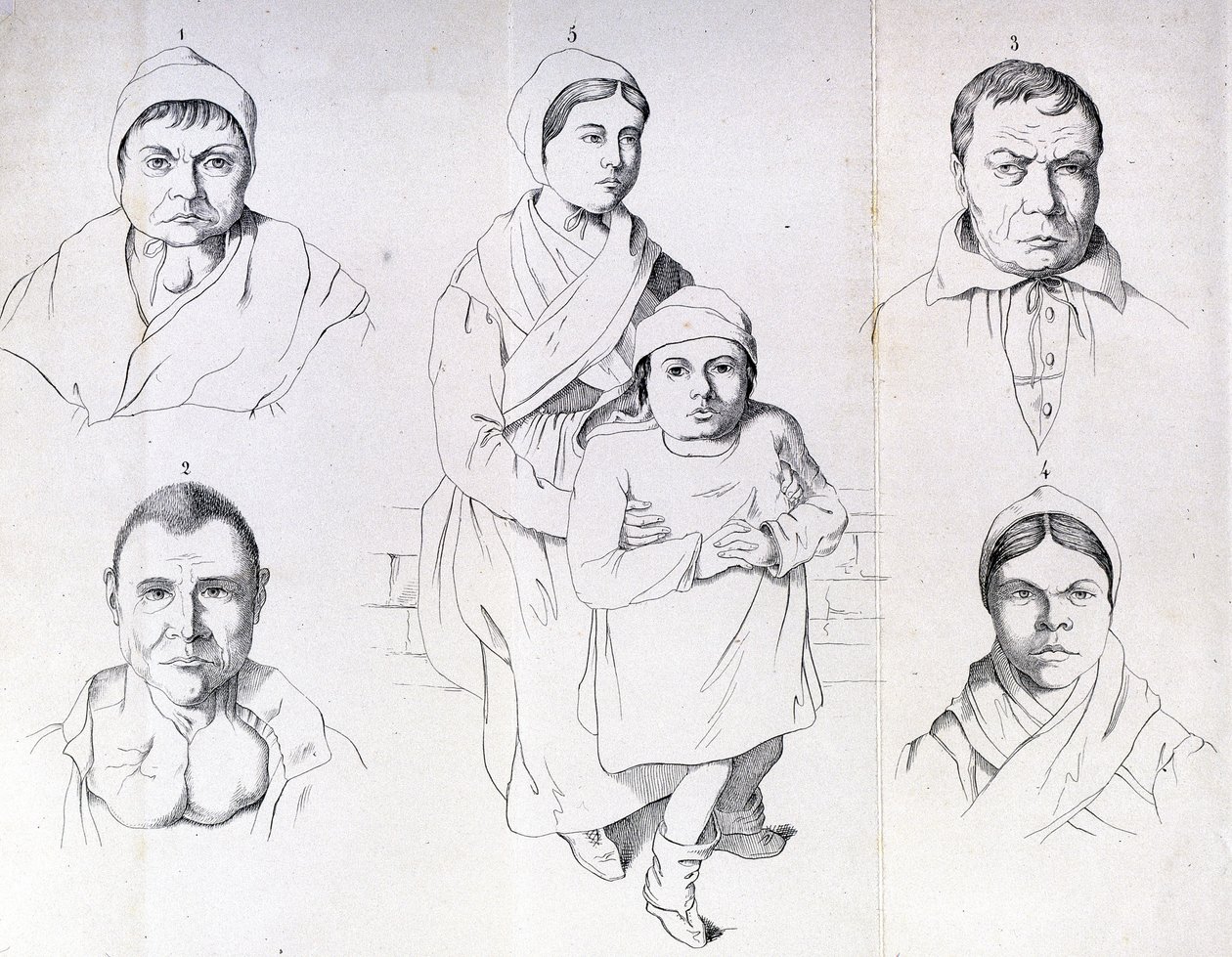 Rozważania nad przyczynami endemicznego kretynizmu Morela. autorstwa Unknown artist