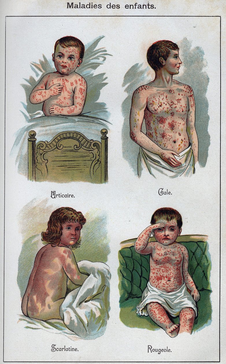 Choroby dzieci: pokrzywka, odra, świerzb, szkarlatyna. W „Nowym naturalnym leku” F.E. Bilz. autorstwa Unknown artist