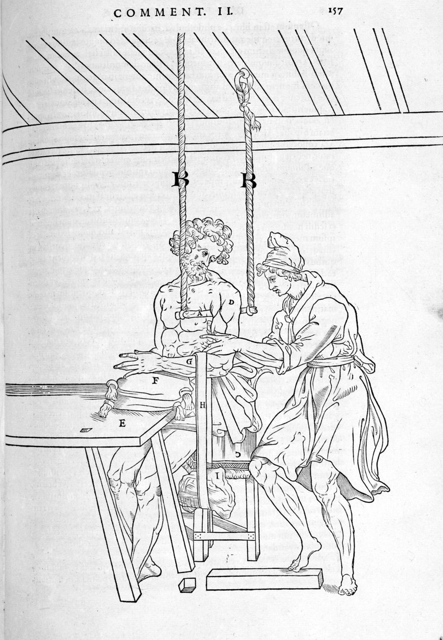 Redukcja złamań. Talerz ilustrowany „Rozcięcie ludzkiego ciała na trzy części...” Carlo Stefano Riverio, Paryż 1545 autorstwa Unknown artist