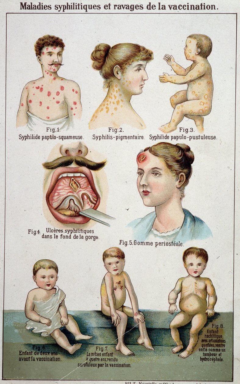 Tablica ilustrująca różne akademiki chorób syfilitycznych i niebezpieczeństwa szczepień - w Bilz medycyna naturalna, koniec XIX wieku. autorstwa Unknown artist