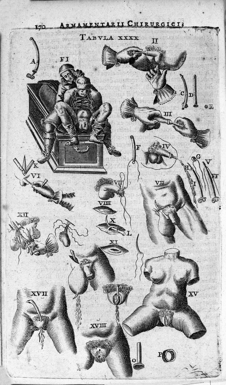 Interwencje chirurgiczne na płci żeńskiej i męskiej. Grawer w „Armamentarium Surgical” J. Scultetusa, Wenecja autorstwa Unknown artist