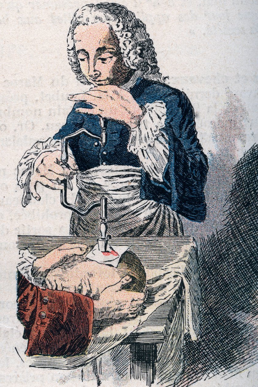 Trepanacja. Druk z XVIII wieku. autorstwa Unknown artist