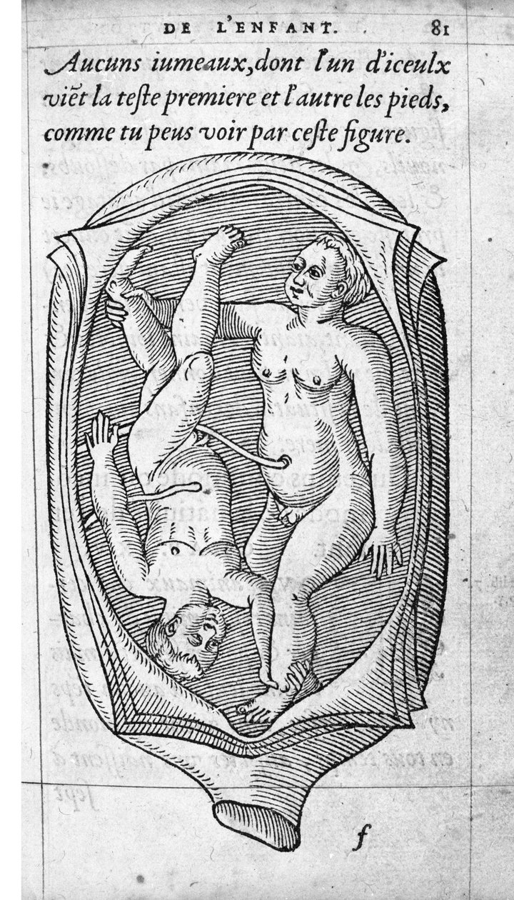 Pozycja płodu w macicy podczas ciąży. Rycina z „De la generation des enfants” autorstwa francuskiego lekarza i chirurga Ambroise Pare (1509-1590) XVI wiek autorstwa Unknown artist
