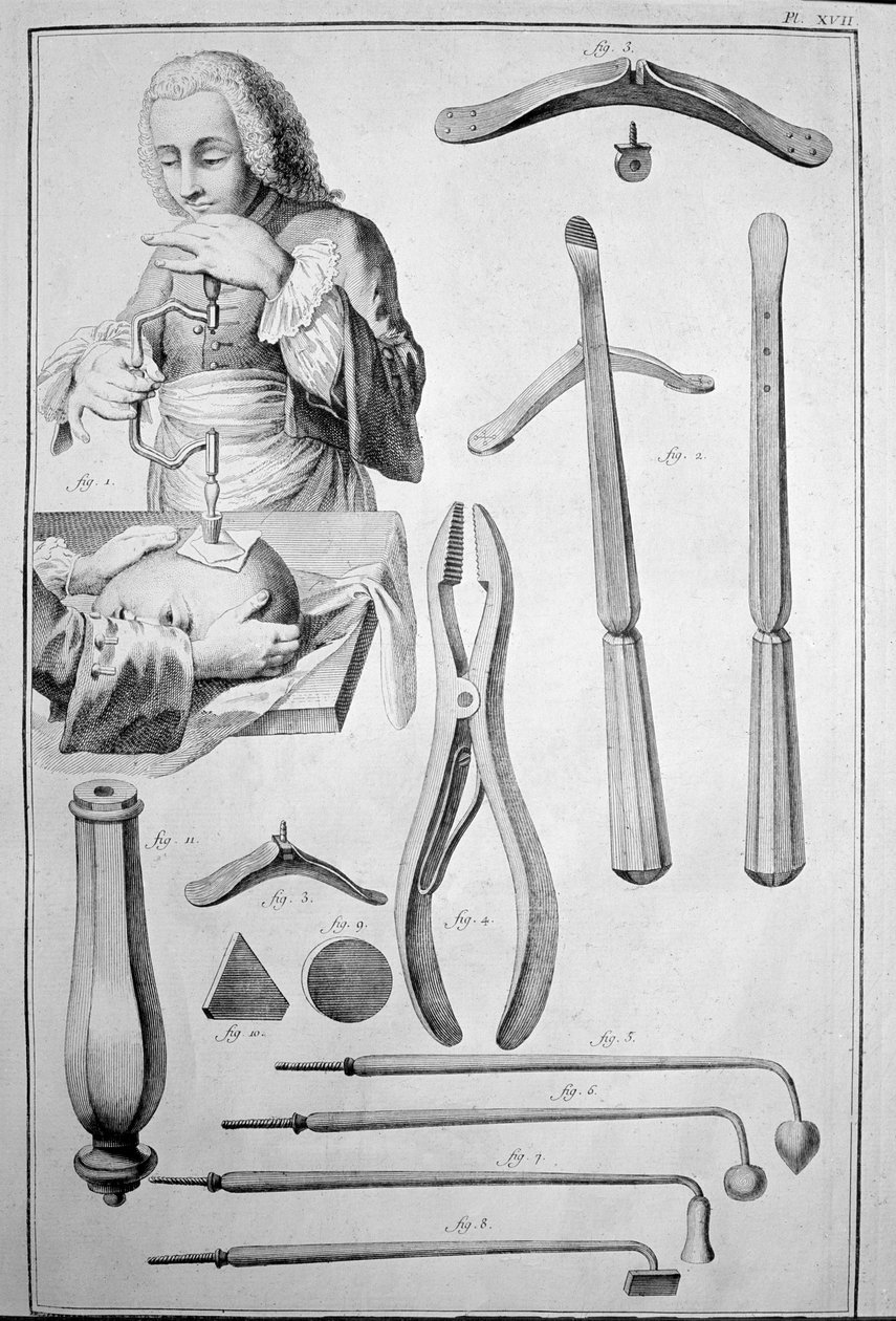 Trepanacja czaszki, różne instrumenty (grawerowanie autorstwa Unknown artist