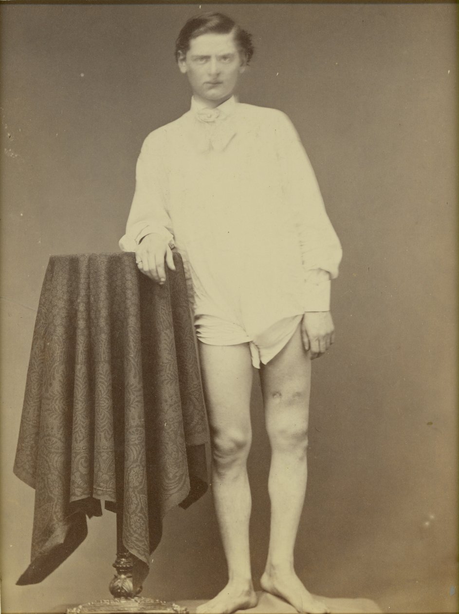 Ranny żołnierz wojny secesyjnej (Private Charles Westerfield, Army Medical Museum Specimen No. 4278), kwiecień 1865, 1865 (odbitka albuminowa) autorstwa William Abraham Bell