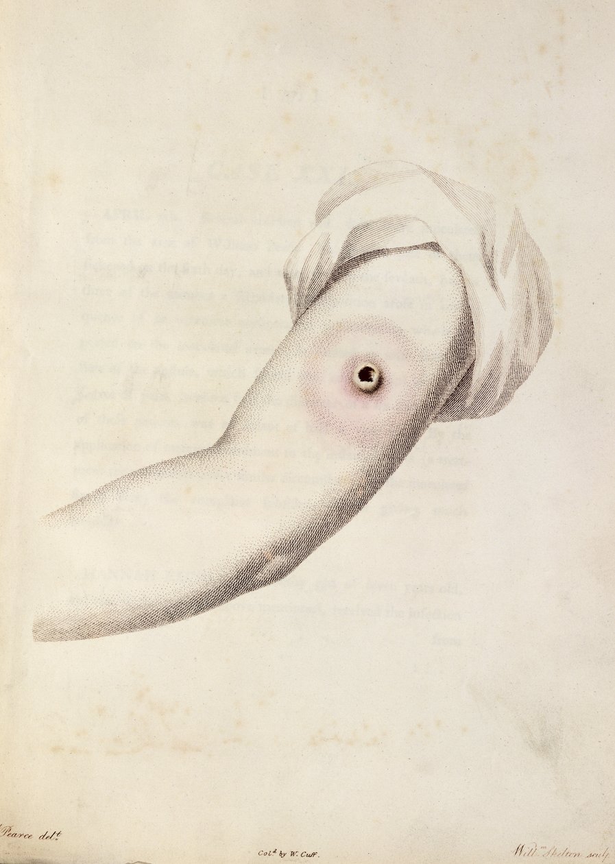 Krosta krowianki na ramieniu, z „An Inquiry into the Causes and Effects of Variolae Vaccinae” Edwarda Jennera (1749-1823) rytowana przez Pearce