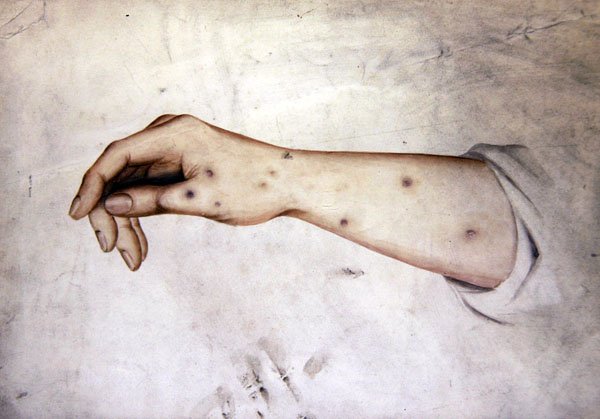 Studium przedramienia ze stanem skóry, ok. 1850 (akwarela na papierze) autorstwa William Lover
