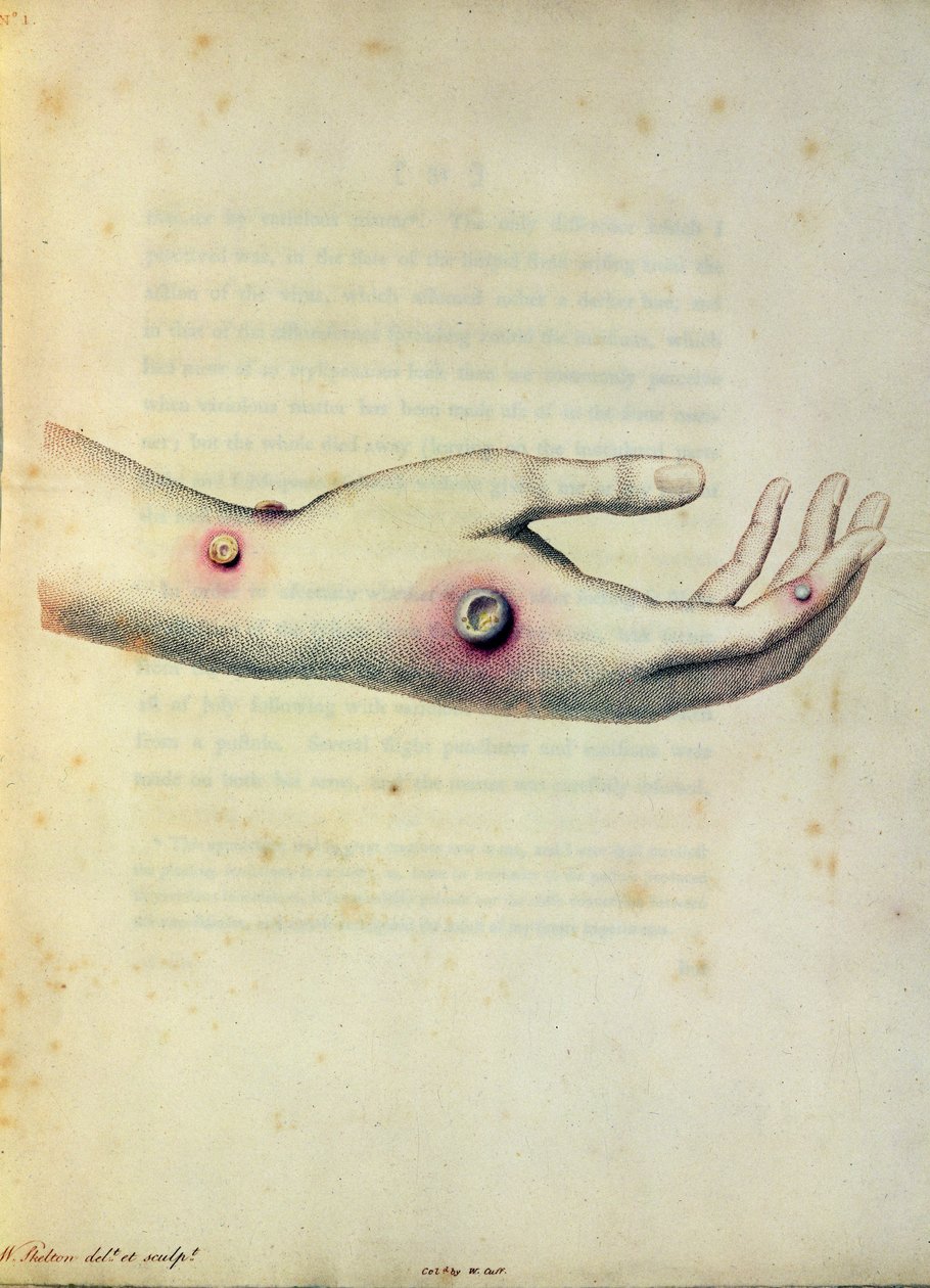Krosta krowianki na ramieniu Sarah Nelmes, z „Aninquiry into the Causes and Effects of the Variolae Vaccinae” Edwarda Jennera (1749-1823), grawerowana przez Pearce