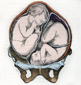 Przedstawienie prawidłowego ułożenia dwóch płodów podczas ciąży bliźniaczej Rycina z „” La nature et l