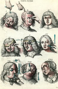 Chirurgia w XVIII wieku: Trepanacja i operacja oka i twarzy. Grawerowanie w „Institutions chirurgicale” Lorenza Heistera autorstwa Anonymous Anonymous