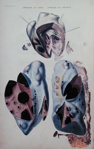 Apopleksja serca i płuc, płyta ilustracyjna z „Anatomie pathologique du corps humain” Jeana Cruveilhiera (1791-1874), wydanej w Paryżu