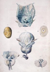 Choroby pęcherza moczowego i prostaty, z „Anatomie Pathologique du Corps Humain” Jeana Cruveilhiera (1791-1874) 1828-42 (kolorowa rycina)
