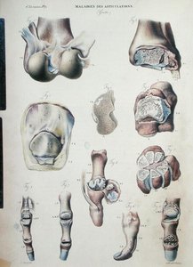 Choroby stawów, z „Anatomie Pathologique du Corps Humain” Jeana Cruveilhiera (1791-1874) 1828-42 (kolorowa rycina)
