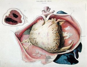 Zapalenie osierdzia, płyta przedstawiająca choroby serca z „Anatomie pathologique du corps humaine” Jeana Cruveilhiera (1791-1874), wydanej w Paryżu