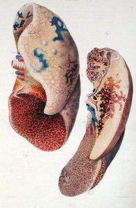 Zapalenie płuc, z „Anatomie Pathologique du Corps Humain” Jeana Cruveilhiera (1791-1874) 1828-42 (kolorowe grawerowanie)