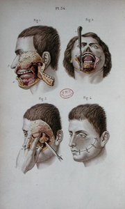 Anatomiczna płytka górnej szczęki autorstwa C and Huette E. Bernard