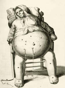 Odprowadzanie płynów z ropnia przez Frederika Dekkersa, 1694 autorstwa Dutch School