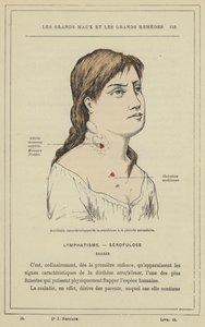 Charakterystyczne przypadki skrofulozy w okresie wtórnym (litografia kolorowa) autorstwa French School
