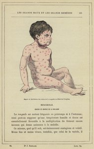 Wygląd i rozmieszczenie plam odry na początku erupcji (litografia kolorowa) autorstwa French School