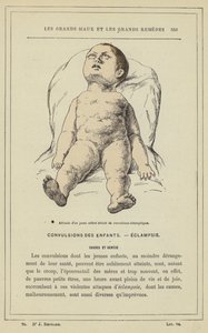 Postawa małego dziecka z drgawkami rzucawkowymi (litografia kolorowa) autorstwa French School