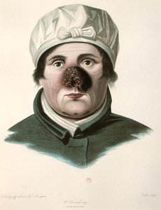 Przed operacją przeszczepu skóry, z „Selecta Praxis Medico-Chirurgica” Alexandra Auverta, Paryż autorstwa French School