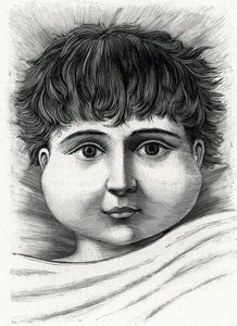 Dziecko z chorobą świnki (rycina) 1888 autorstwa French School