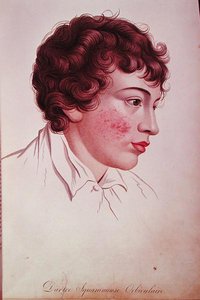 Sucha łata, z „Description des Maladies de la Peau” Barona Jeana Louisa Aliberta (1768-1837) autorstwa French School