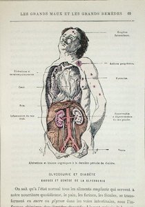 Skutki cukrzycy, z „Les Grands Meaux et les Grands Remedes” dr J. Rengade, Paryż autorstwa French School