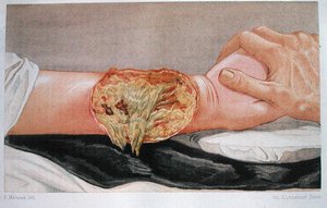Zgorzel szpitalna, z „Traite de Chirurgie de Guerre”, autorstwa Edmunda Delorme
