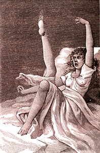 Histeria, zjawisko skrajnie psychiczne, psychozy i psychonerwice.1887 (ryc.) autorstwa French School
